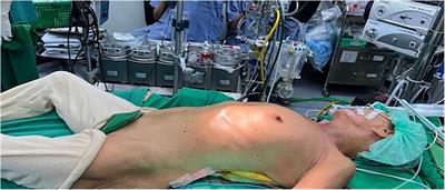 Off-pump minimally invasive coronary artery bypass grafting in patients with left ventricular dysfunction: the lampang experience